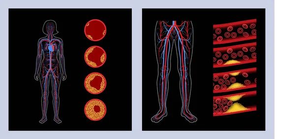 外周血管疾病 — 图库矢量图片