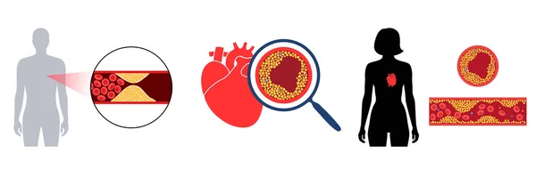 Cardiopathie du cholestérol — Image vectorielle