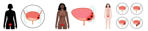 Stades de cancer de la vessie — Image vectorielle