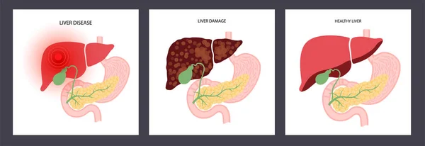 Begrip leverziekte — Stockvector