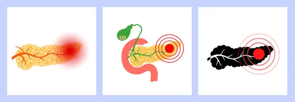 胰腺疾病和癌症 — 图库矢量图片