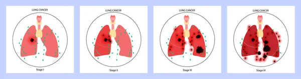 Choroba raka płuc — Wektor stockowy