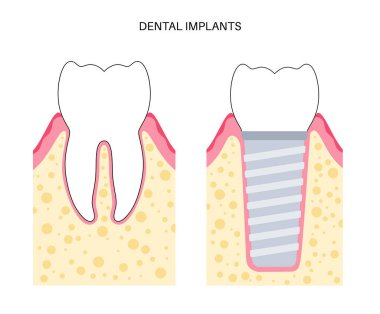 Dental implant prosedürü