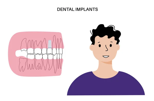 Fogászati implantátum eljárás — Stock Vector