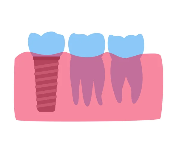 Zubní implantát postup — Stockový vektor
