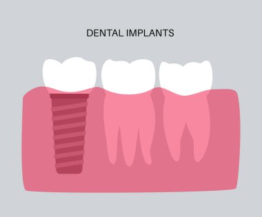 Dental implant prosedürü