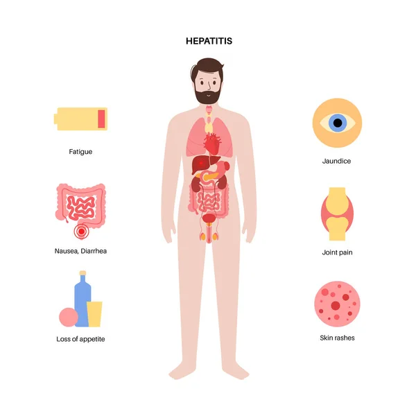 Autoimmun hepatit sjukdom — Stock vektor