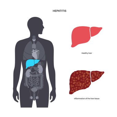 Otoimmün hepatit hastalığı