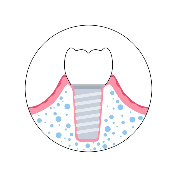 Zubní implantát postup — Stockový vektor