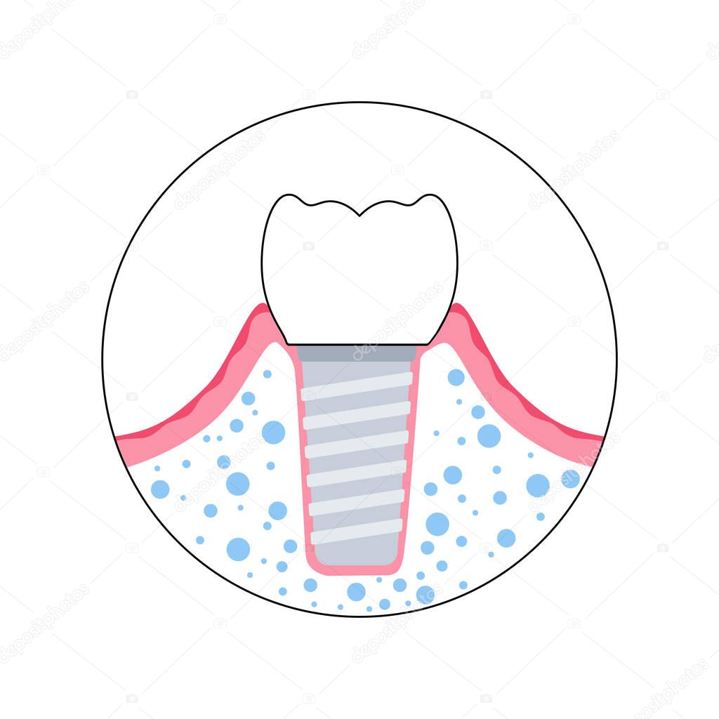 Dental implants surgery concept. Anatomical poster with human teeth. Prosthesis in mouth. Crown abutment and screw medical poster isolated flat vector illustration for clinic or education. .