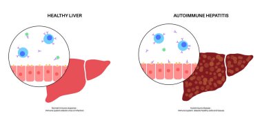 Otoimmün hepatit hastalığı