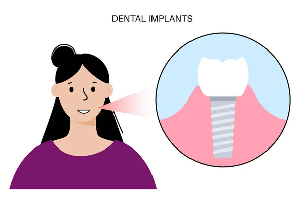 Procédure d'implant dentaire — Image vectorielle