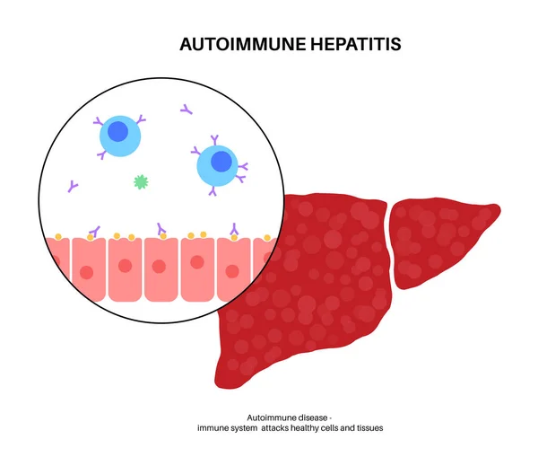 Epatite autoimmune — Vettoriale Stock