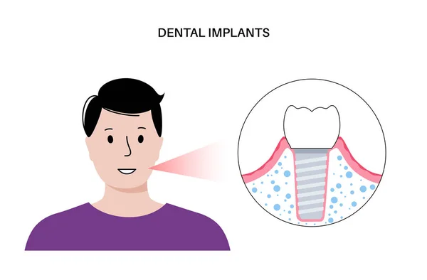 Fogászati implantátum eljárás — Stock Vector