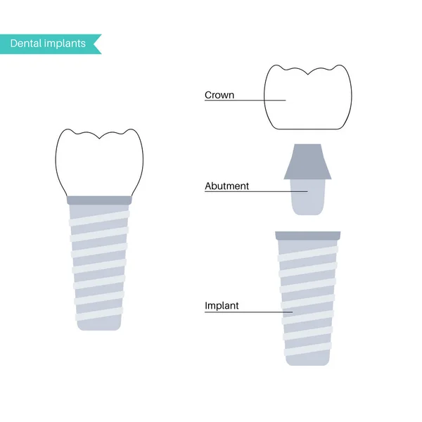 Procedimiento de implante dental — Archivo Imágenes Vectoriales