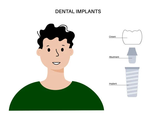 Dental implant procedure — Stockvector