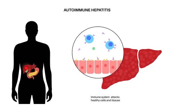 Autoimmun hepatit sjukdom — Stock vektor