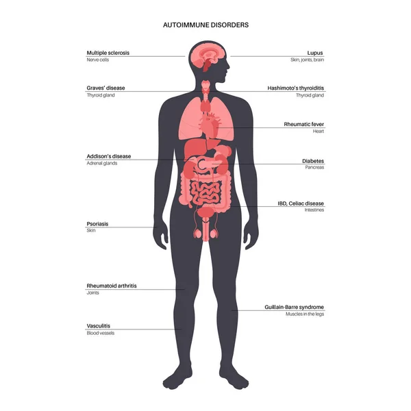 Autoimmune disorders diseases — Vettoriale Stock