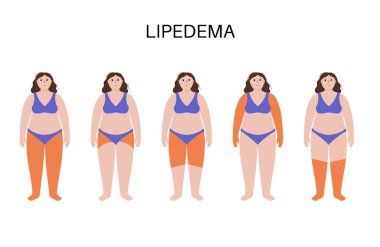 Lipedema hastalığı konsepti. Kadın vücudunun aşık kısmında yağ birikiyor. Kalça, kalça ve baldır sorunları. Selülit, aşırı kilolu ve şişmiş. Doku bozukluğunu düz vektör illüstrasyonuna çevir