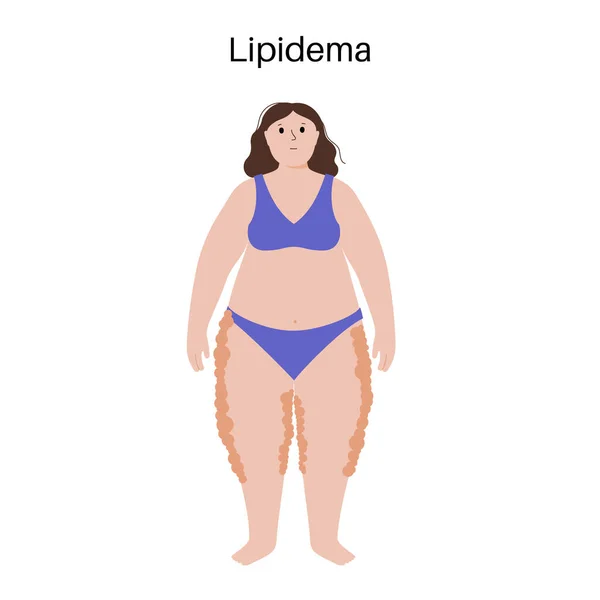 リープデマ病の概念 女体の恋人部分に脂肪を蓄積 および子牛の問題 セルライト 太りすぎと腫れ 脂肪組織障害フラットベクトル図 — ストックベクタ