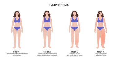 Lymphedema disease concept. Stages of swelling of female leg. Damaged lymph nodes in human obesity body. Overweight problem and elephantiasis. Disorder in the lymphatic system flat vector illustration clipart