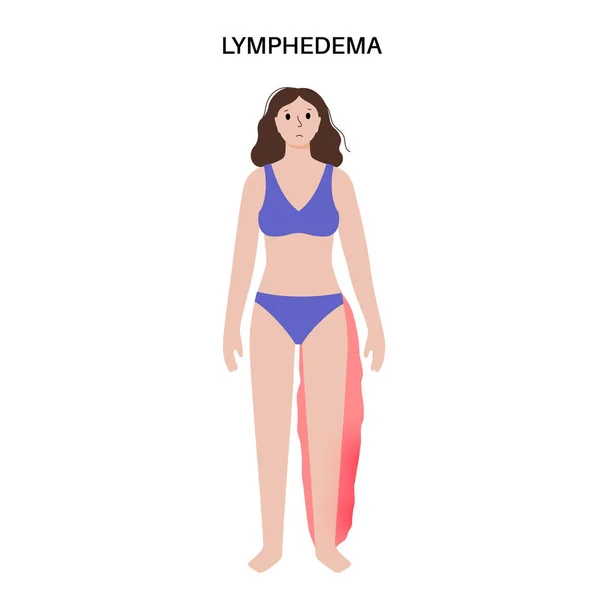 Lymphœdème Concept Maladie Gonflement Des Jambes Des Bras Féminins Ganglions — Image vectorielle