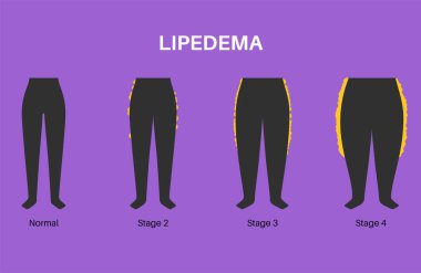 Lipedema hastalığı konsepti. Kadın vücudunun aşık kısmında yağ birikiyor. Kalça, kalça ve baldır sorunları. Selülit, aşırı kilolu ve şişmiş. Doku bozukluğunu düz vektör illüstrasyonuna çevir