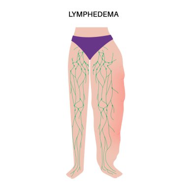 Lymphedema disease concept. Swelling of female legs or arms. Damaged lymph nodes in human obesity body. Overweight problem and elephantiasis. Disorder in the lymphatic system flat vector illustration. clipart