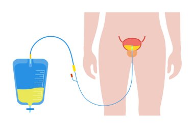 Erkek vücudunda idrar sondası. Mesaneyi boşalt ve bacak torbasında idrar topla. Üretra 'dan iç organlara tüp. Urethral drenaj ekipmanı. Prostat büyümesi, doğal olarak işeme zorluğu..