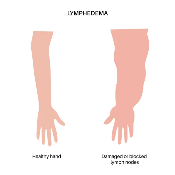 Hand Lymfedeem Ziekte Concept Zwelling Van Vrouwelijke Armen Beschadigde Lymfeklieren — Stockvector