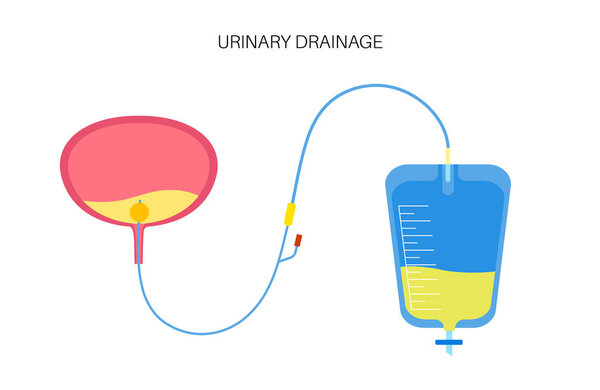 Urinary catheter in the human body. Empty bladder and collect urine in a leg bag. Tube from urethra to internal organ. Urethral drainage equipment. Difficulty peeing naturally flat vector illustration