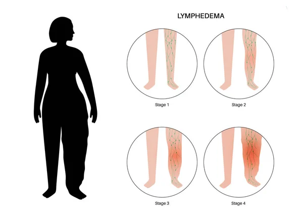 Koncepcja Choroby Lyymphedema Etapy Obrzęku Kobiecej Nogi Uszkodzone Węzły Chłonne — Wektor stockowy