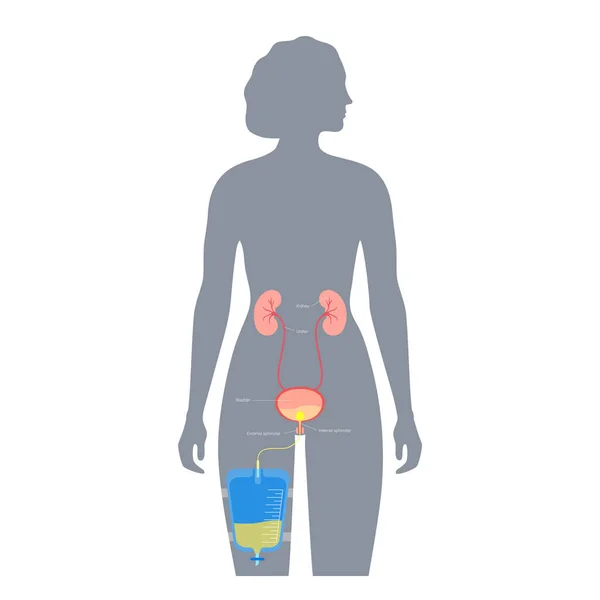 女性の体内の尿道カテーテル 膀胱を空にして足袋に尿を集める 内臓から尿道までチューブ 尿道排水装置 自然フラットベクトル図を見るのは難しい — ストックベクタ