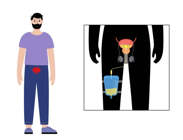 男性の体内の尿道カテーテル 膀胱を空にして足袋に尿を集める 尿道から内臓までチューブ 尿道排水装置 自然界のベクトルを見るのは難しい — ストックベクタ