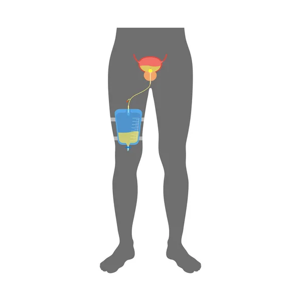 男性体内的尿道导管 排空膀胱 收集尿液在一个脚袋里 从尿道到内脏的输尿管 排尿设备 前列腺肿大 自然排便困难 — 图库矢量图片