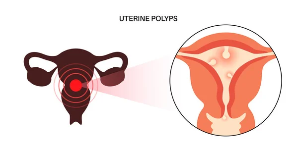 Livmoderpolyper Anatomi Endometriesjukdom Överväxt Celler Livmodern Och Endometriet Kvinnors Hälsa — Stock vektor