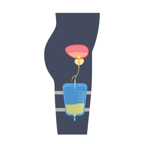 男性体内的尿道导管 排空膀胱 收集尿液在一个脚袋里 从尿道到内脏的输尿管 排尿设备 前列腺肿大 自然排便困难 — 图库矢量图片