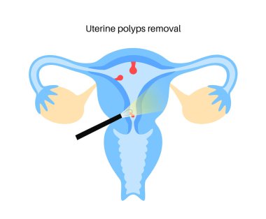 Uterine polyps removal. Endometrial disease. Overgrowth of cells in the uterus and endometrium. Woman health concept. Cause of irregular menstrual bleeding and infertility flat vector illustration. clipart
