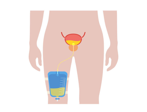 Urinary catheter in male body. Empty bladder and collect urine in a leg bag. Tube from urethra to internal organ. Urethral drainage equipment. Prostate enlargement, difficulty peeing naturally vector.
