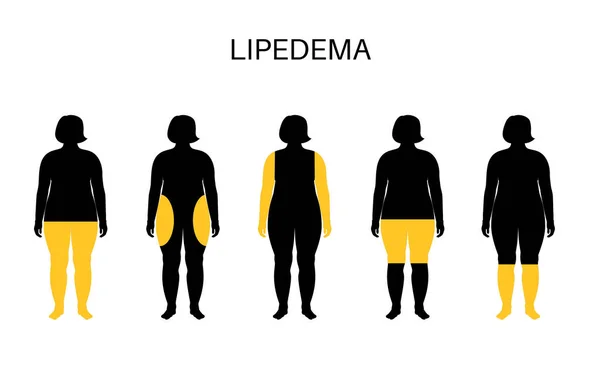 Lipedema hastalığı konsepti. Kadın vücudunun aşık kısmında yağ birikiyor. Kalça, kalça ve baldır sorunları. Selülit, aşırı kilolu ve şişmiş. Doku bozukluğunu düz vektör illüstrasyonuna çevir