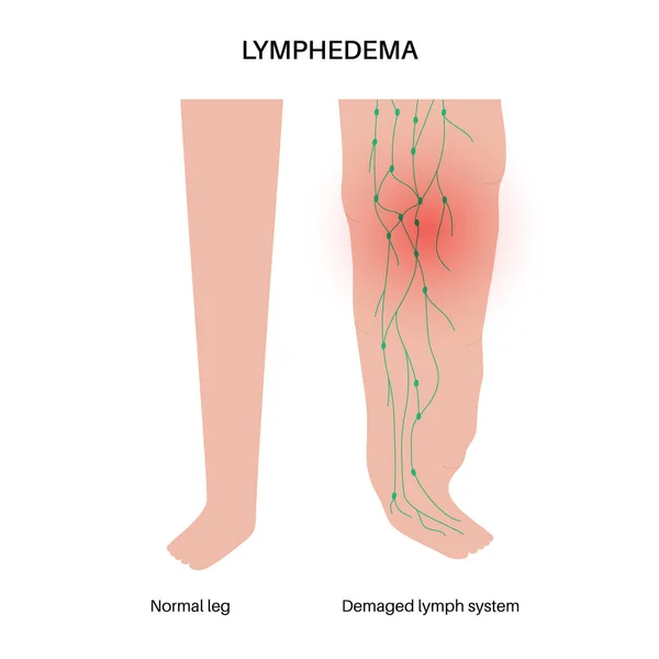 Lymfoedeem Ziekte Concept Zwelling Van Vrouwelijke Benen Armen Beschadigde Lymfeklieren — Stockvector