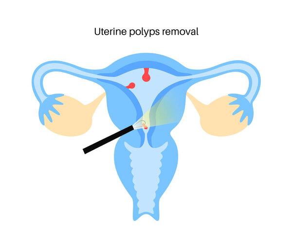 Uterine polyps removal. Endometrial disease. Overgrowth of cells in the uterus and endometrium. Woman health concept. Cause of irregular menstrual bleeding and infertility flat vector illustration.