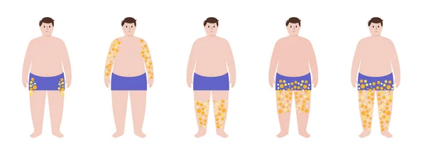 Obezite Aşırı Kilolu Hastalık Kavramı Kadın Vücudunun Bazı Kısımlarında Yağ — Stok Vektör