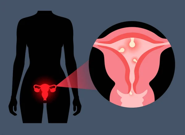 子宮ポリープの解剖学 子宮内膜疾患 子宮や子宮内膜の細胞の過剰増殖 女性の健康の概念 不規則な月経出血や不妊フラットベクトルイラストの原因 — ストックベクタ