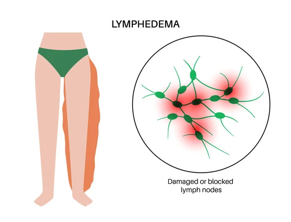 Lenf Kanseri Hastalığı Konsepti Kadın Bacakları Kolları Şişmiş Nsan Obezitesindeki — Stok Vektör