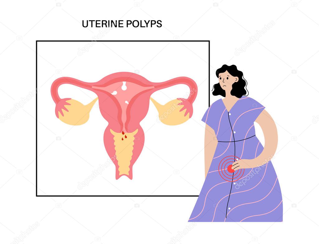 Uterine polyps anatomy. Endometrial disease. Overgrowth of cells in the uterus and endometrium. Woman health concept. Cause of irregular menstrual bleeding and infertility flat vector illustration.