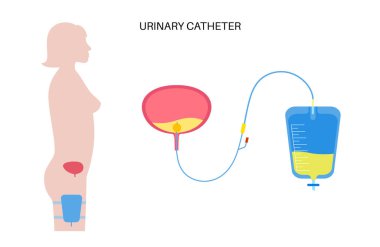 Kadın vücudunda idrar sondası var. Mesaneyi boşalt ve bacak torbasında idrar topla. İç organlardan üretraya tüp. Urethral drenaj ekipmanı. Doğal düz vektör illüstrasyonunda işeme zorluğu