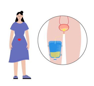Kadın vücudunda idrar sondası var. Mesaneyi boşalt ve bacak torbasında idrar topla. İç organlardan üretraya tüp. Urethral drenaj ekipmanı. Doğal düz vektör illüstrasyonunda işeme zorluğu