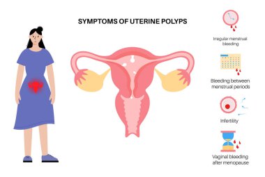 Rahim içi polipleri sendromları. Endometriyal hastalık. Rahim ve endometriyumdaki hücrelerin aşırı büyümesi. Kadın sağlığı konsepti. Düzensiz adet kanaması ve kısırlık düz vektör çizimi.