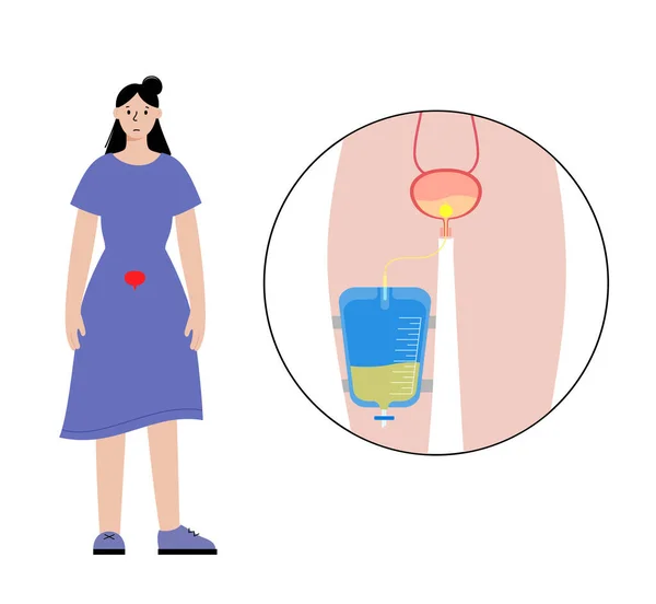 排尿导管在女性体内 排空膀胱 在脚袋中收集尿液 从内部器官到尿道的管子 排尿设备 难尿自然扁平病媒图解 — 图库矢量图片